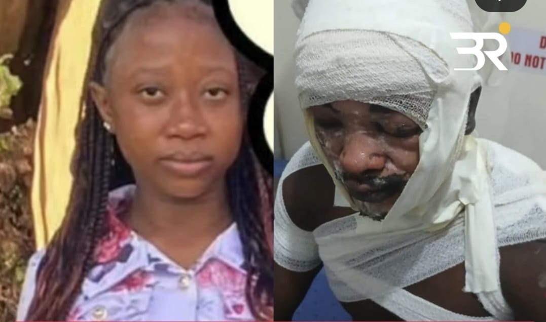 Nairobi man suffers savere burns after girlfriend burns him with hot water on valentines day